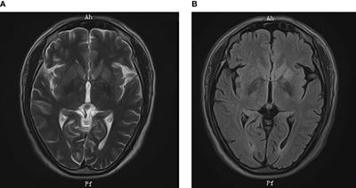 Case report: Anti-IgLON5 disease and anti-LGI1 encephalitis following COVID-19